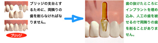 インプラント治療