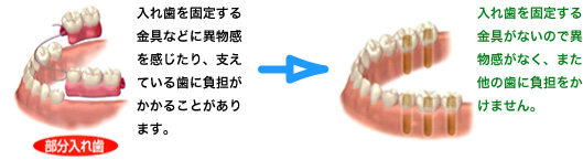 インプラント治療