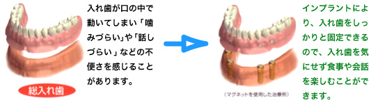 インプラント治療