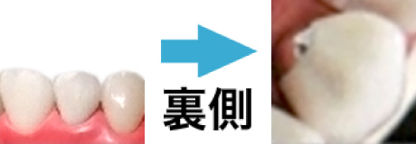 メタルセラミック